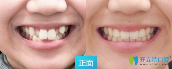 深圳拜尔口腔28岁顾客矫正牙齿前后对比照