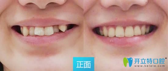 深圳拜尔口腔张苑芳医生成年人虎牙矫正前后对比效果