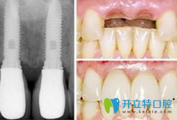 成都格林口腔<!--<i data=20240703-sp></i>-->忠院长种植牙案例图