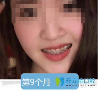 成年人的我佩戴牙套第9个月的效果