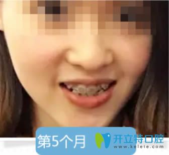 金属托槽牙齿矫正5个月