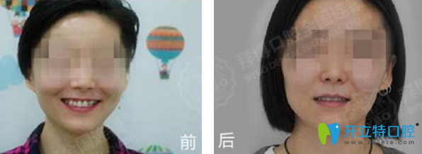 拜博口腔正畸前后效果对比 拜博口腔正畸前后效果对比