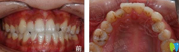 天津拜博口腔隐形矫正牙齿前 天津拜博口腔隐形矫正牙齿前
