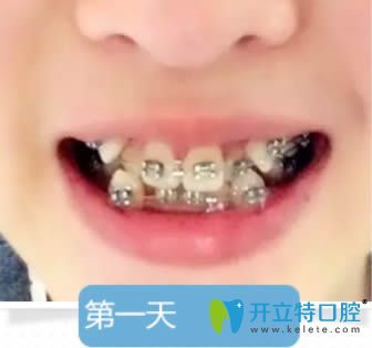 佩戴金属牙套天