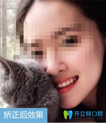 28岁的我在深圳拜尔佩戴自锁金属托槽12个月的效果