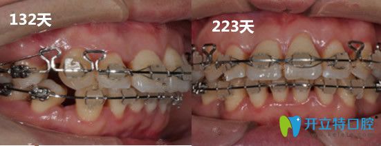 广州圣贝口腔牙齿矫正变化过程图