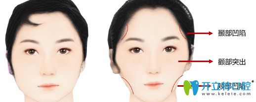 什么是牙套脸? 什么是牙套脸?