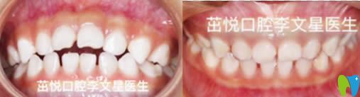 成都茁悦口腔儿童牙齿矫正效果对比图