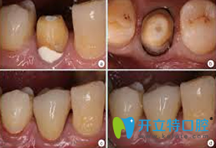 厦门登特口腔杨鸿颖根管治疗前后效果对比图