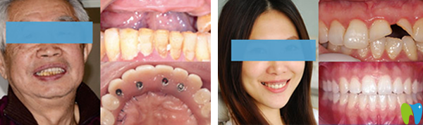 拜博半口牙缺失种植+牙齿缺损修复效果图
