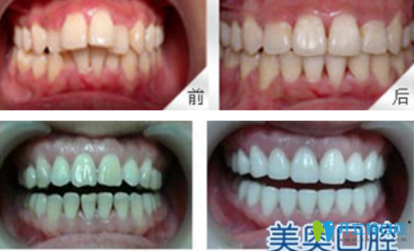 美奥口腔龅牙矫正+牙齿美容修复效果案例