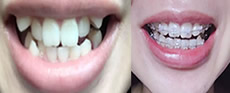 无锡臻品口腔看一下我在无锡臻品口腔做牙齿矫正100天的对比图 变化大吗