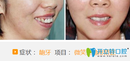 聊城哪家医院牙齿正畸好?看聊城口腔微笑全隐形牙齿矫正案例对比图 聊城哪家医院牙齿正畸好?看聊城口腔微笑全隐形牙齿矫正案例对比图