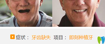 属于聊城口腔医院的牙齿缺失即刻种植牙案例 属于聊城口腔医院的牙齿缺失即刻种植牙案例