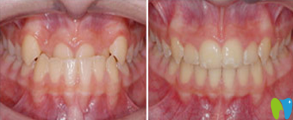 宁波牙博士口腔牙齿矫正案例效果图