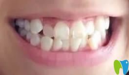 沈阳博得口腔30岁戴牙套能矫正牙齿吗?看我在沈阳博得口腔牙齿正畸效果