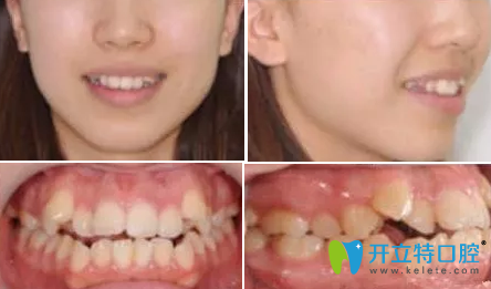 28岁牙齿矫正需要几年？看宁波牙博士口腔医生用案例解答