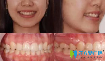 宁波牙博士口腔28岁牙齿矫正后效果