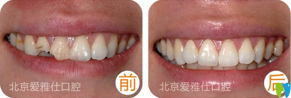 北京爱雅仕牙科诊所牙齿美容修复效果案例