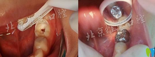 杨占娟乳牙龋坏做牙髓治疗前后对比案例