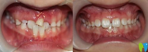 找闫立文做前牙反合+乳牙滞留矫正治疗的案例