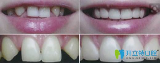 成都维朗口腔杨阳牙齿修复效果图