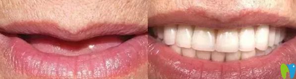 金铂利口腔种植牙案例