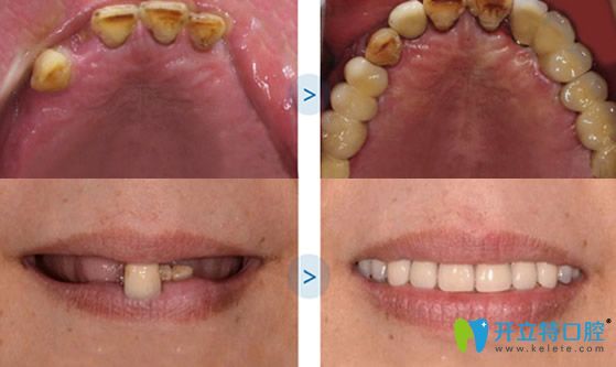 福建维乐口腔好吗？看维乐口腔种植牙案例效果对比图