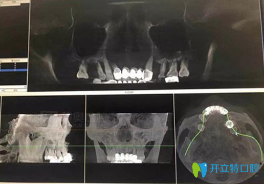 患者周先生CBCT口腔影像