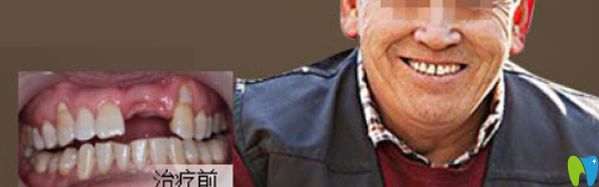 牙缺失种植牙齿前后效果对比