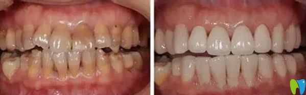 齿康口腔氟斑牙美白修复效果