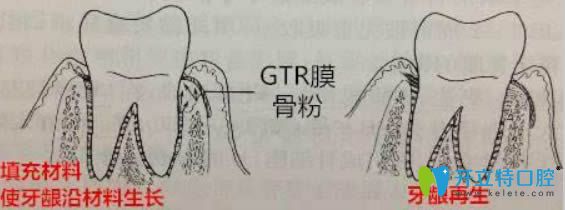 开立特牙龈再生术图解