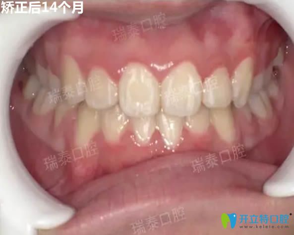 时代天使隐形矫正14个月后效果图 时代天使隐形矫正14个月后效果图
