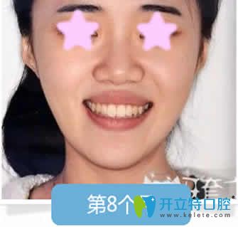 我在杭州格莱美口腔做隐形牙齿矫正后第8个月照片