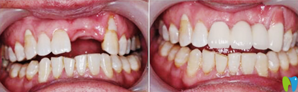 齿康口腔牙齿种植效果案例