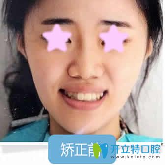 我在杭州格莱美口腔做牙齿矫正前照片