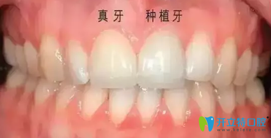 齿康口腔牙齿种植后