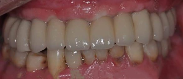 南京金台口腔65岁半口牙缺失即刻种植牙案例 惊叹全场粉丝