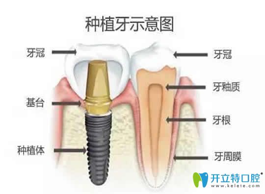无锡康贝佳口腔医生揭露：比种植牙更好的方法及价格