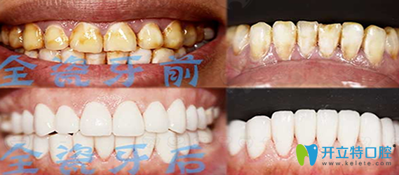 金圣口腔重度氟斑牙全瓷贴面修复案例