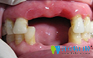 在北京维乐口腔做微创无痛种植牙前 在北京维乐口腔做微创无痛种植牙前