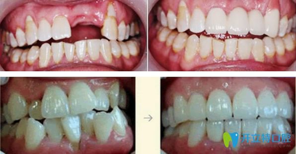 门牙缺失种植+牙齿拥挤错位矫正后效果