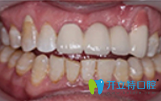 北京维乐口腔种植牙后照片 北京维乐口腔种植牙后照片