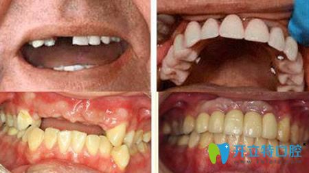 陈献礼单颗牙缺失种植案例+多颗牙缺失种植案例
