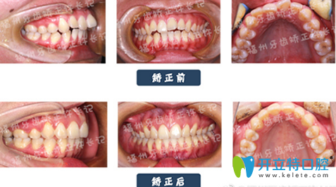 许长记龅牙矫正案例