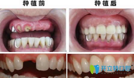 <!--<i data=20240703-sp></i>-->齿科<!--<i data=20240703-sp></i>-->种植牙案例效果图