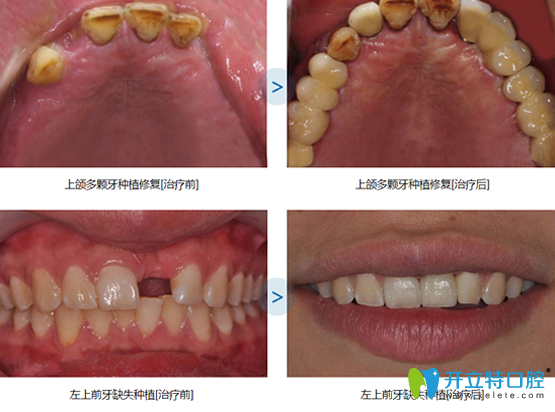 多颗牙缺失种植+单颗门牙缺失种植案例