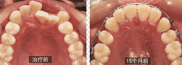 在广州壹加壹口腔自锁托槽矫正牙齿15个月了 舍不得拆牙套