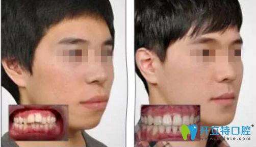 佛山壹加壹口腔矫正牙齿前后对比照 佛山壹加壹口腔矫正牙齿前后对比照