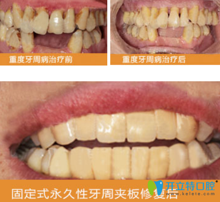 重度慢性牙周炎固定式性牙周加班修复前后对比图